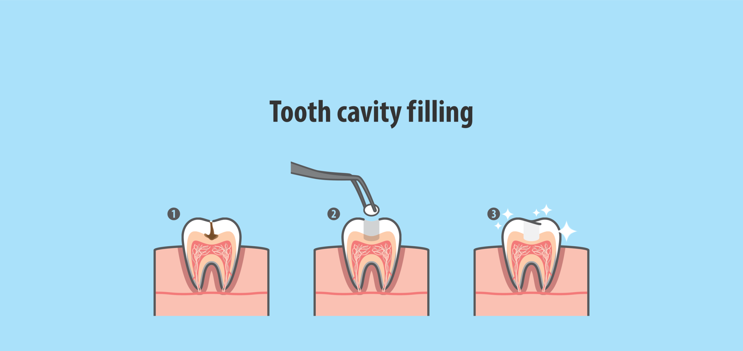 Process of Dental Fillings