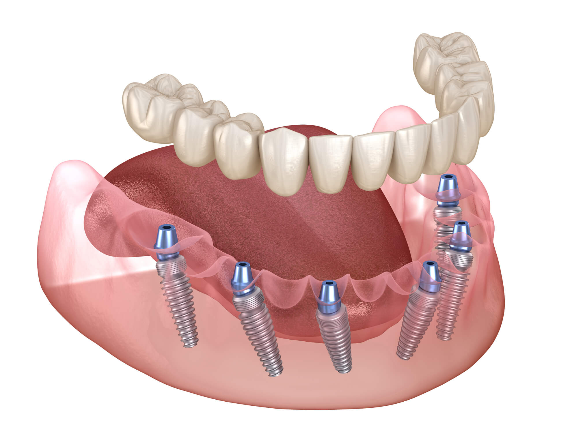 What is All on X Dental Implants?