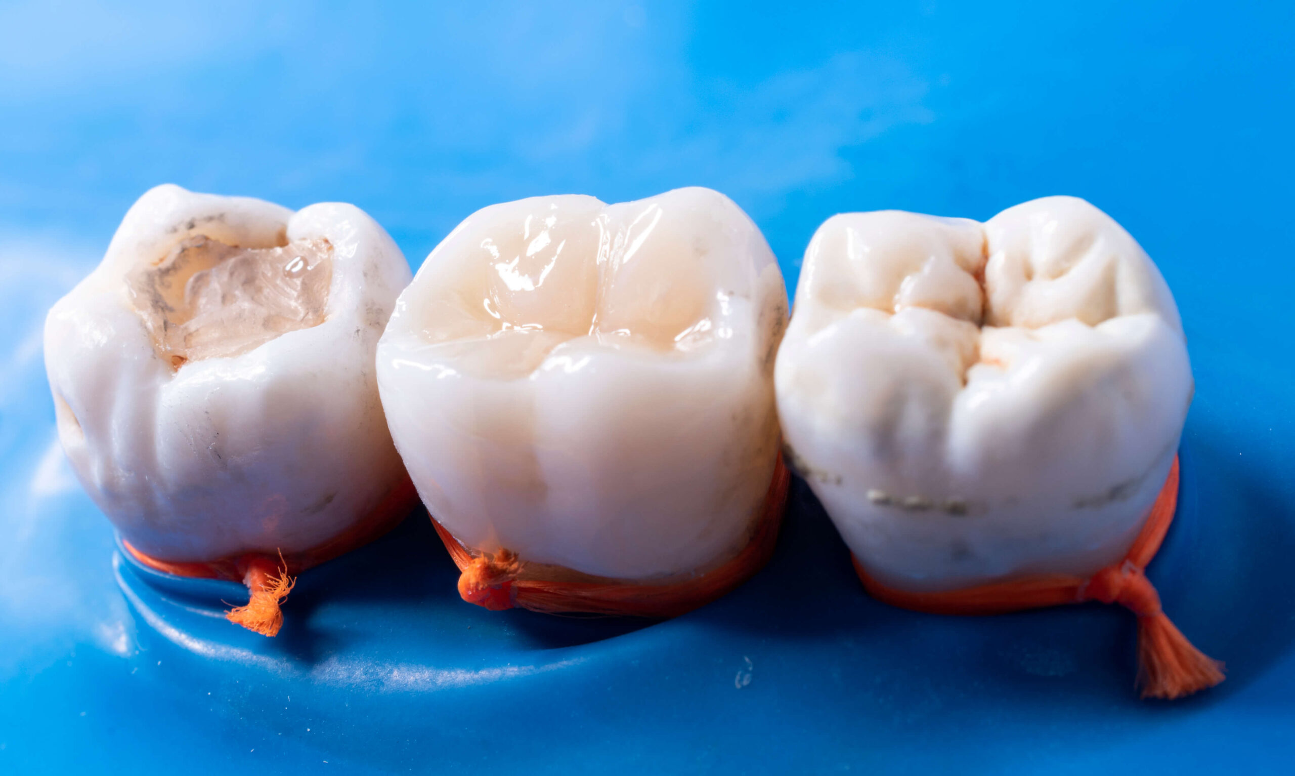What is Dental Fillings?
