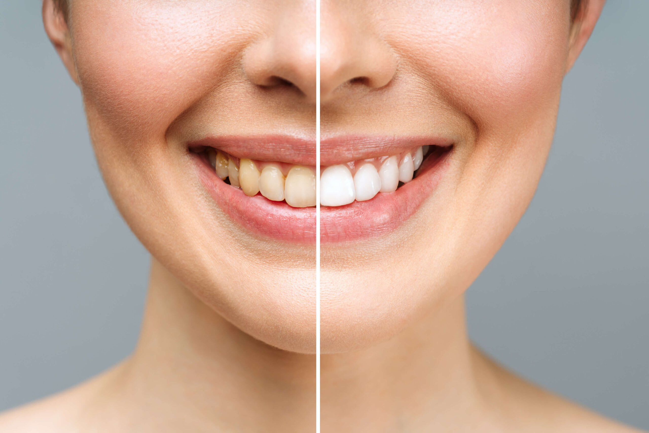 What is Teeth Whitening?