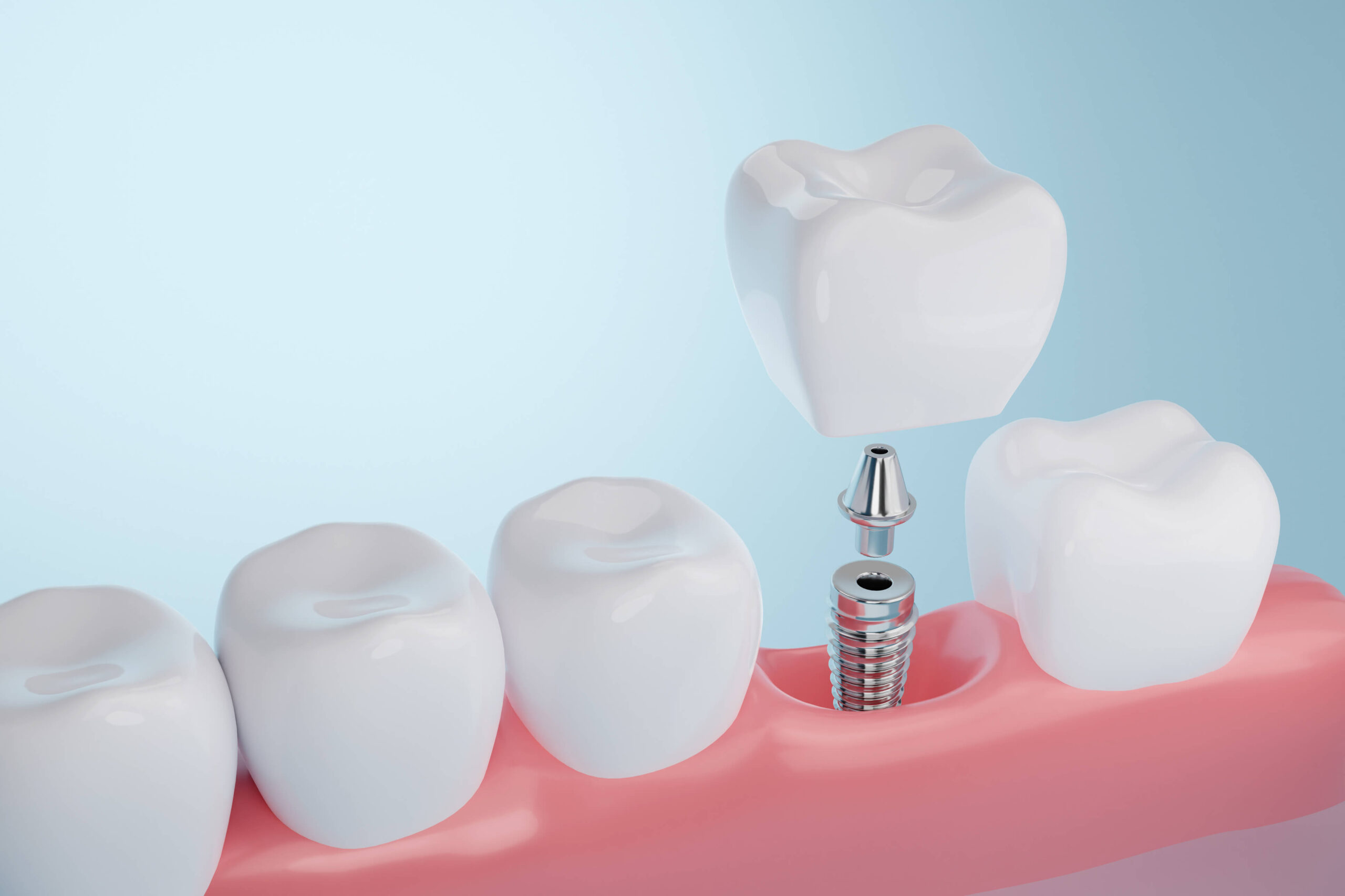 Understanding Dental Implants