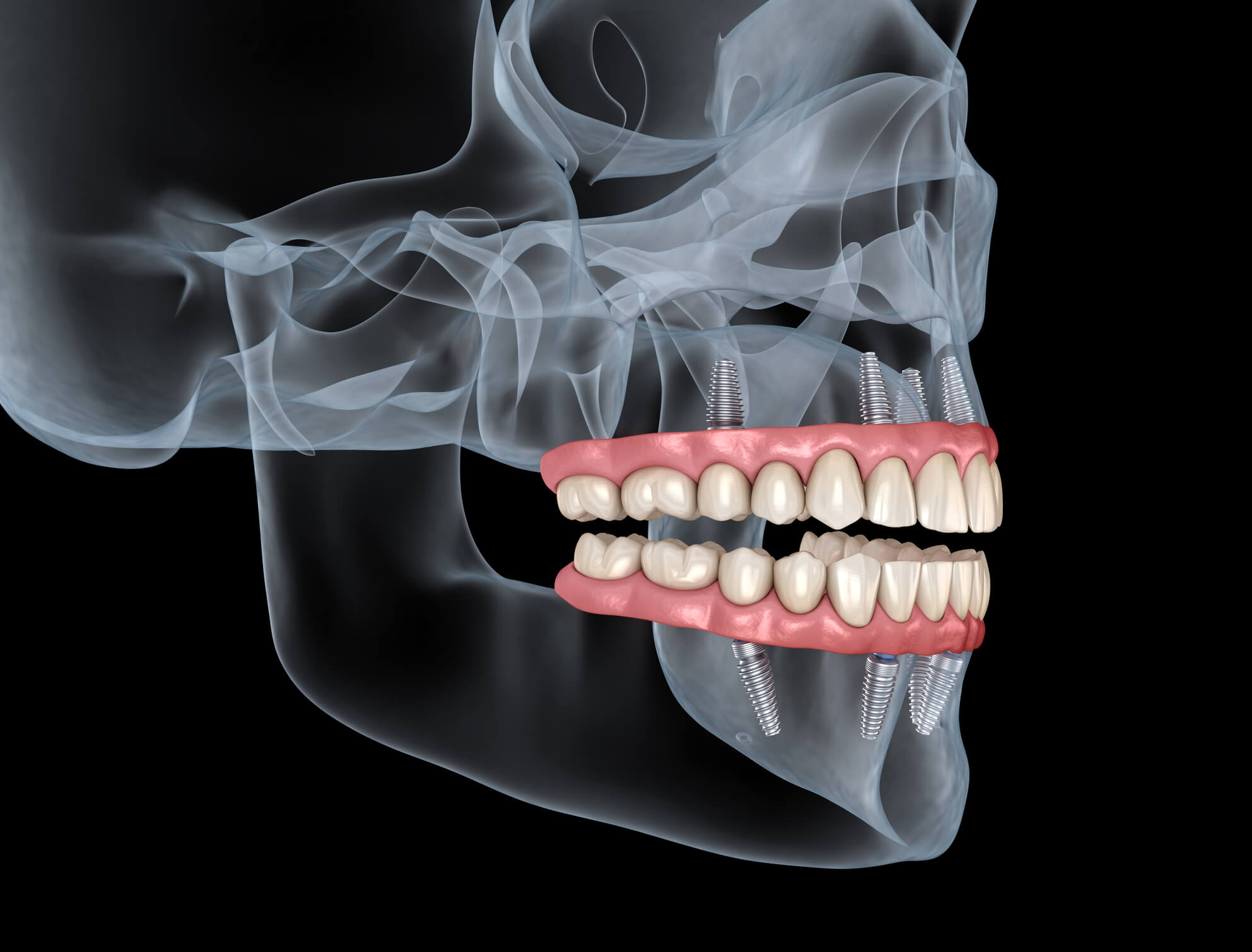 How Does the Process of All on X Dental Implants Work?
