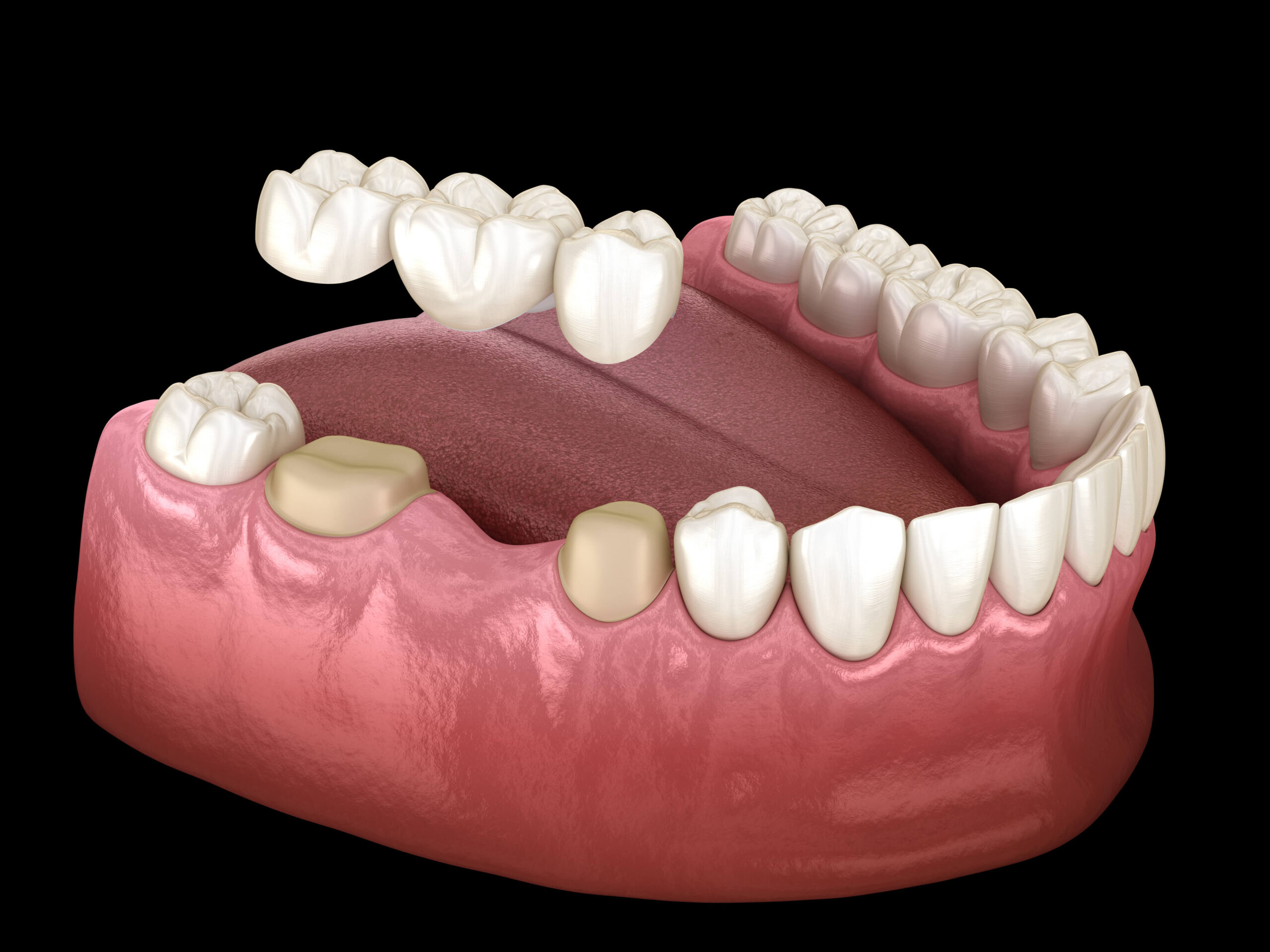 Understanding Dental Bridges