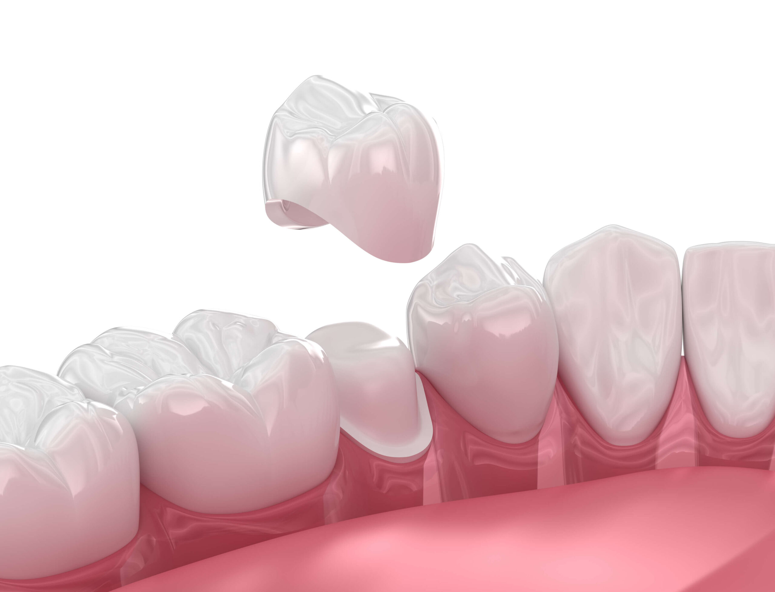 Understanding Dental Crowns