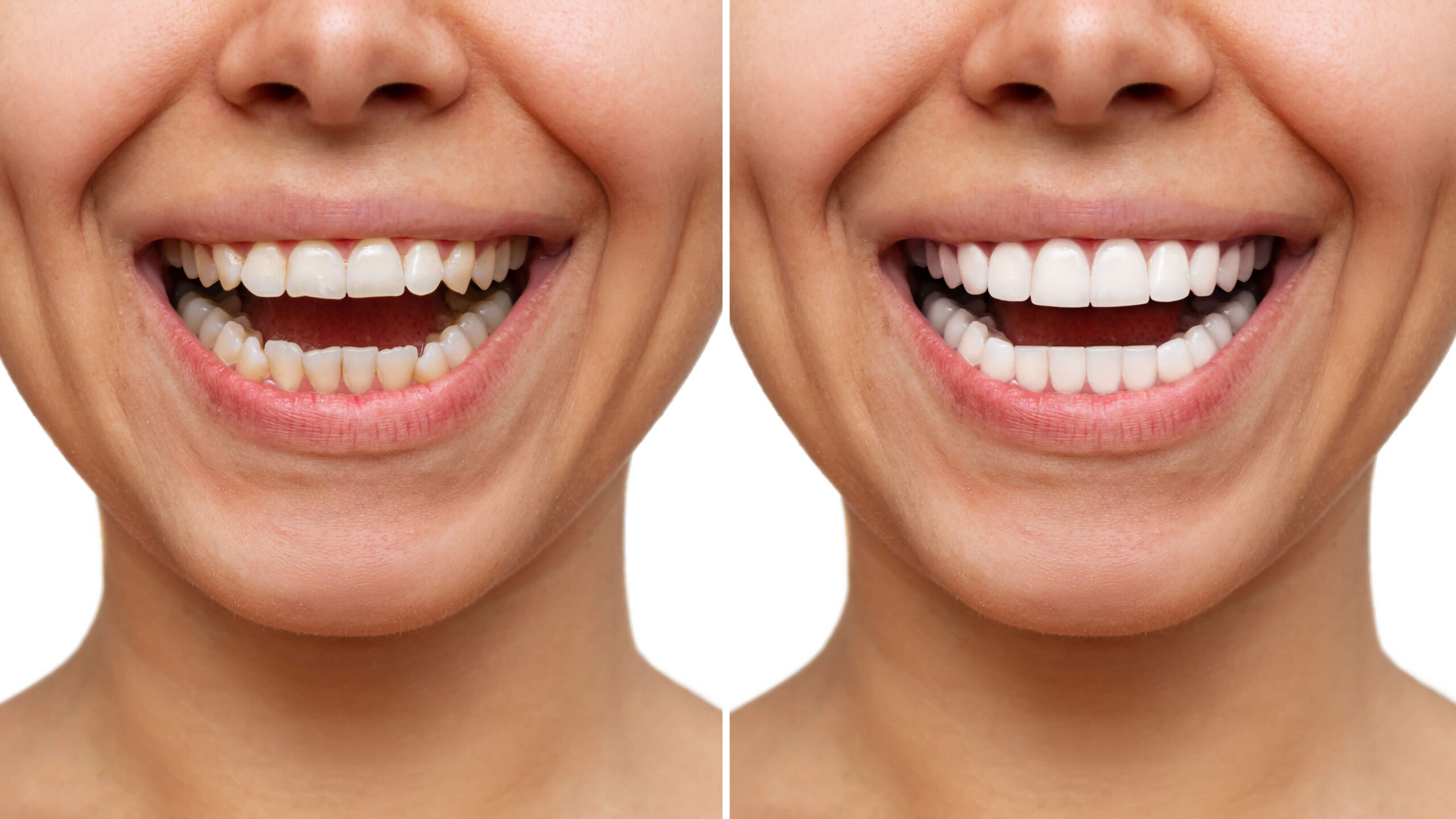 What are Dental Veneers?
