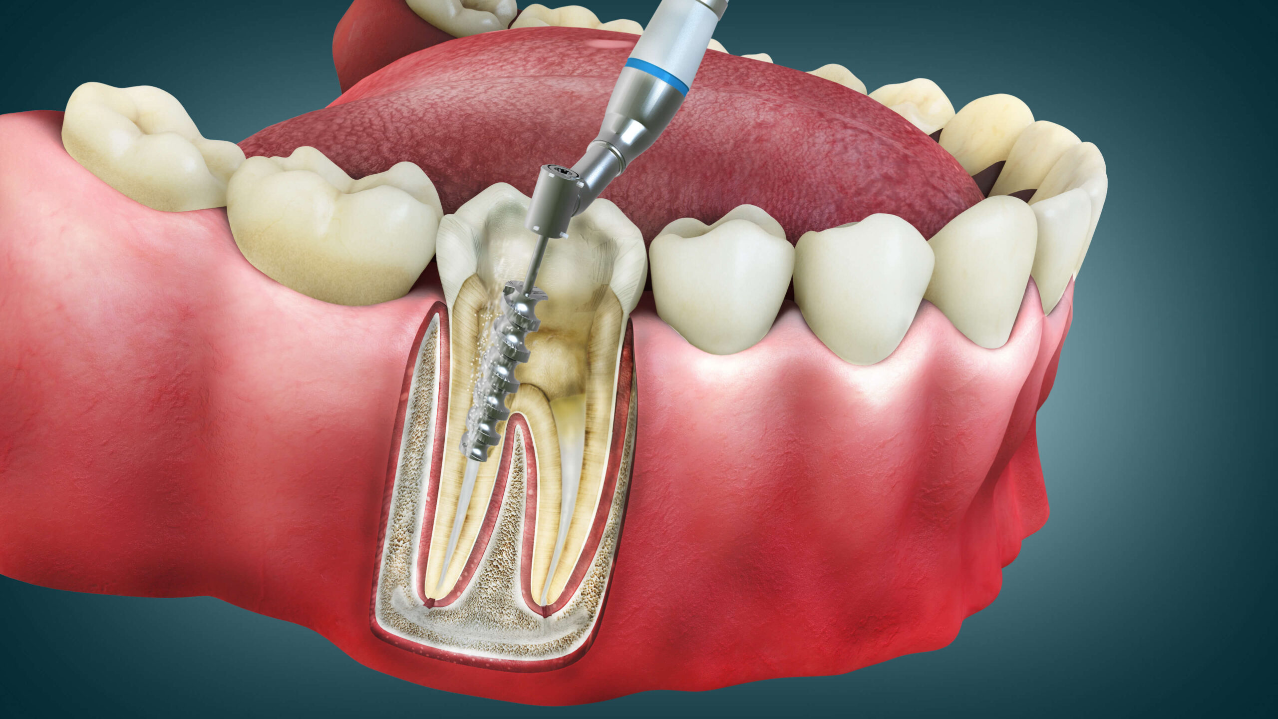 Our Approach to Root Canal Treatment