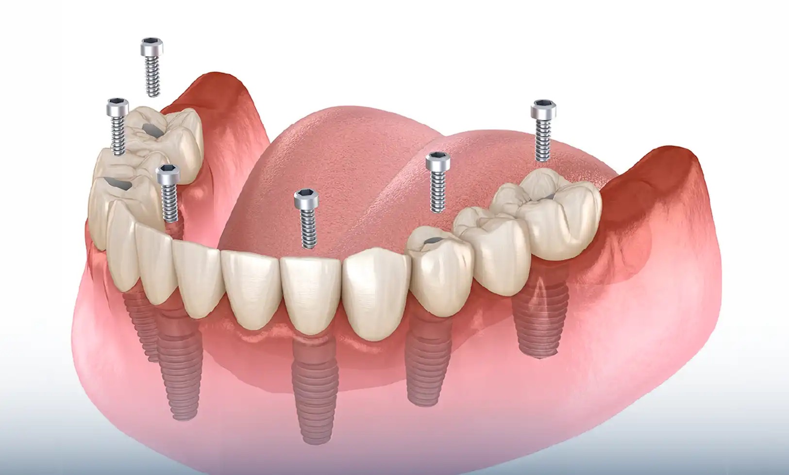 How All-on-X Differs from Traditional Dentures